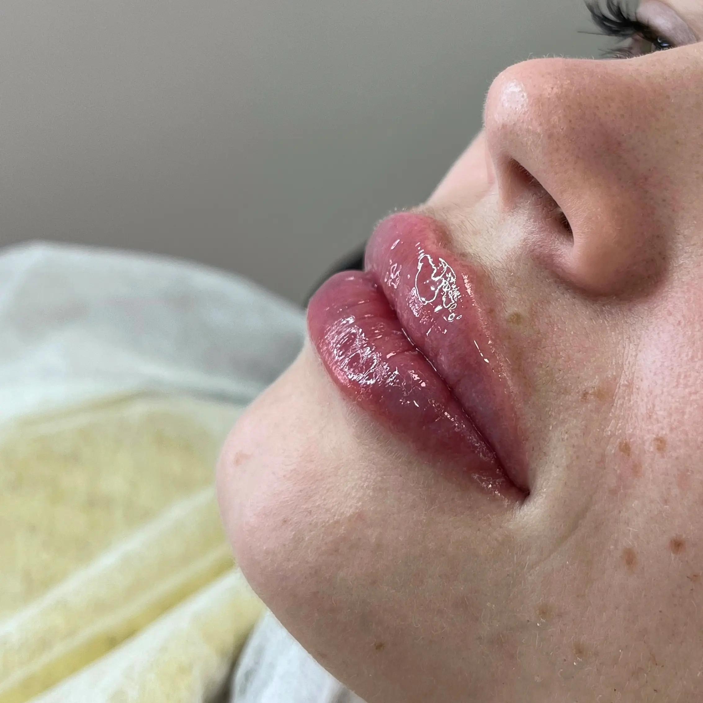 Аугментація губ - це чудовий спосіб підкреслити свою красу та збільшити об'єм губ. 